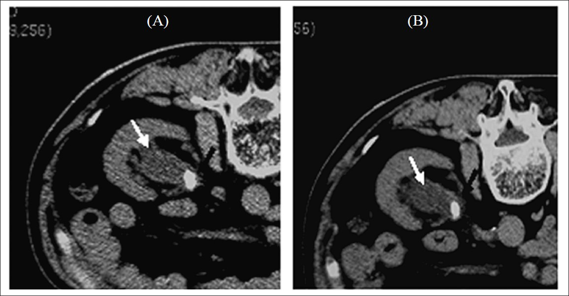 Indirect signs of upper urinary tract calculus were detected in all 28 patients on both low-dose CT and standard-dose CT images, with 28 cases of nephrohydrosis; of which 20 cases showed renal enlargement on some different degrees. A 63-year-old man with left upper ureteral calculus: upper abdomen axial low-dose CT image (120 kV, 25 mAs, pitch of 1.00, 7-mm collimation) shows a ureteral stone (black arrow), renal enlargement, and nephrohydrosis (white arrow) (A). The same findings are shown on the standard-dose CT image (120 kV, 100 mAs, pitch of 1, 7-mm collimation) (B).