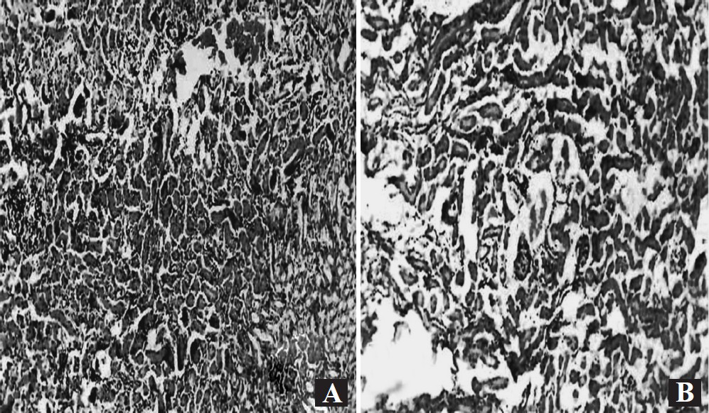 (A) Photomicrograph showing severe renal tissue inflammation with large number of polymorphonuclear leukocytes, along with destruction of glomeruli and tubules in renal tissue of control group of mice without treatment with cranberry (H & E X 100). (B) Photomicrograph showing mild renal tissue inflammation along with significantly less infiltration of ploymorphonuclear leukocytes in the renal tissue of group of mice undergone treatment with cranberry (H & E X 100).