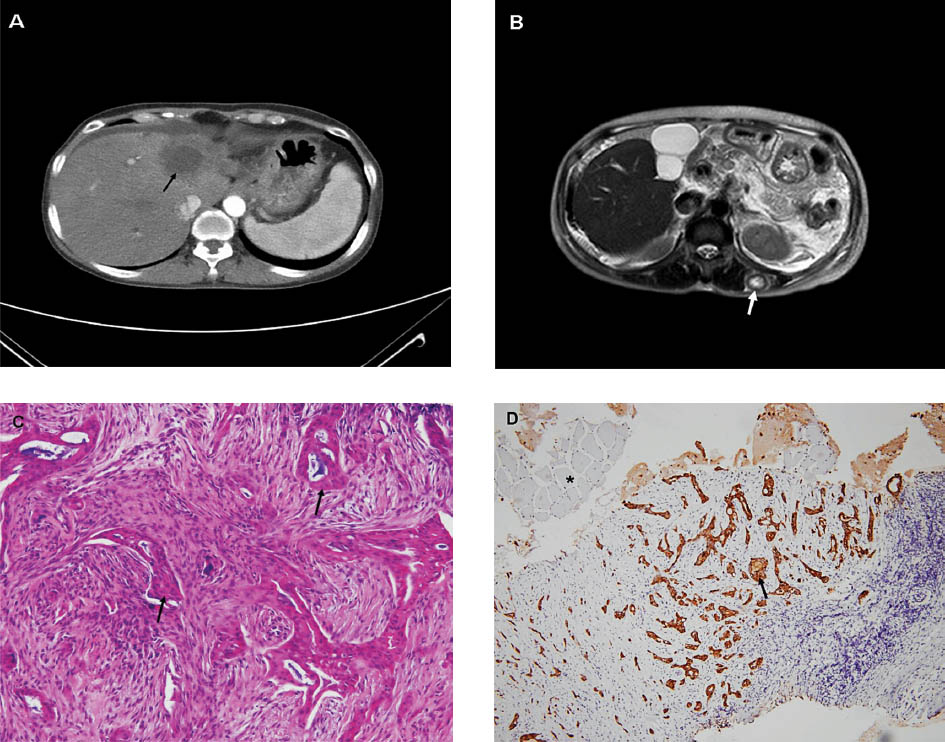 A Computed tomography showed a hypovascular lesion in the left hepatic lobe (arrow) and perihepatic ascites. B. Magnetic resonance imaging revealed a nodular mass over the left longissimus dorsi muscle (arrow). C. Adenocarcinoma (arrows) in muscle tissue. (hematoxylin and eosin stained 400X). D. The tumour cells were positive for cytokeratin 7 (arrow), which invaded into the normal muscle tissue (asterisk mark). (Immunohistochemical stain 100X).