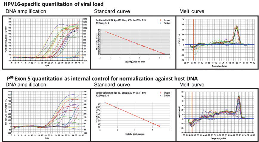 Quantitative real-time PCR of HPV16 URR to determine HPV16 viral load in DNA isolated from cervical precancer and cancer tissue biopsies. Genomic DNA of HPV16 positive cervical precancer and cancer samples was amplified by type-specific HPV16 URR primers using Biorad iQ SYBR Green supermix (as described in Methods). Two-fold serial dilution of WHO HPV16 international standards starting from 5×104 copies/reaction in C33a DNA diluents were used as reference (upper panels). Amplification of p53 exon5 which was used as normalization control for genomic DNA input (lower panels). DNA amplification threshold cycle analysis (left panels); standard curve analysis for determining the efficiency of reaction and calculation of viral copy number and quantitation of host genome equivalents (middle panel); Melt curve analysis showing specificity of HPV16 and p53 exon 5 amplicons were performed in each run (right panel).
