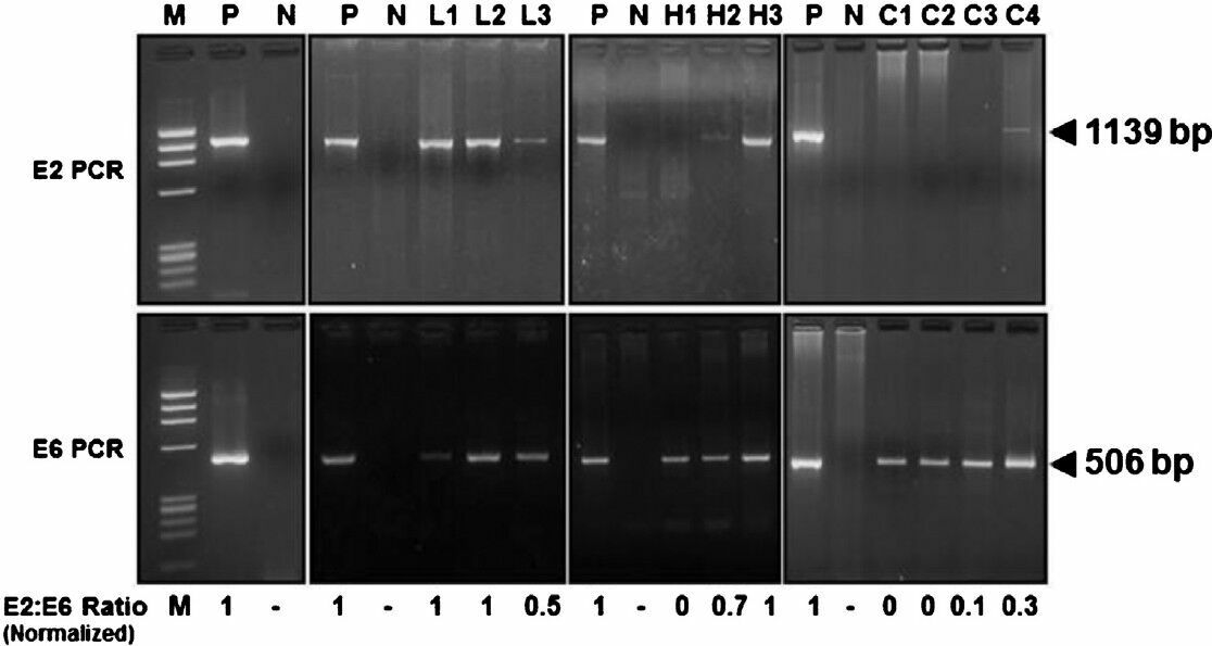 Determination of physical state HPV16 genome in cervical precancer and cancer tissue biopsies by HPV16 E2 and HPV16 E6 amplification. HPV16 E2 and E6 open reading frame (ORFs) were amplified using specific primers, and E2:E6 densitometric ratio was determined as described in ‘Methods’. Vector-free HPV16 full length plasmid harbouring intact E2 and E6 region was used as positive control and as a reference for normalization of E2:E6 ratio in clinical samples. Upper panels showing gel photograph of HPV16 E2 amplification (1139bp) and lower panels show HPV16 E6 amplification (506bp) in DNA of vector control and clinical samples. Normalized E2:E6 ratio of the samples is indicated at the bottom of the respective lane. Normalized E2:E6 ratio = 0 represents completely integrated HPV16 genome, value = 1 represent episomal viral genome, and values between 0 and 1 indicate mixed form of HPV16 genome. M, φX174 HaeIII-digested molecular weight marker; P, HPV16 plasmid; N, PCR negative control (C33a genomic DNA); L1-L3, LSIL cases; H1- H3, HSIL cases; C1- C4, invasive cancer cases.