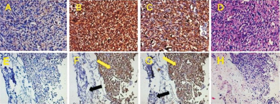 Characterization of human xenografts in mice by immunohistochemistry for anti-human nuclei, human osteopontin and hematoxylin-eosin staining. This figure gives representative immunohistochemistry data of xenograft solid tumours from mouse 209 (panels A to D) and mouse 950 (panels E to H) transplanted with non-pasteurized tumour of sample no. 1 (tumours were obtained from n=3 human samples transplanted). PBS treated mouse paraffin-sections served as negative control (A, E). Panels (D, H) exhibit section tissue morphology by hematoxylin and eosin staining. In xenograft section with anti-human nuclei, all nuclei are strongly stained (panel B). Anti-osteopontin antibody stained nuclear as well as cytoplasmic staining in these sections (panel C). Images in A to D were at magnification 20X. Sections E to H involve some part of mouse skin as tumours were subcutaneous. Yellow arrows show strongly stained human specific nuclei (B) and osteopontin (C) and black arrows show non-stained mouse skin section. All images in E to H were at magnification 10X.