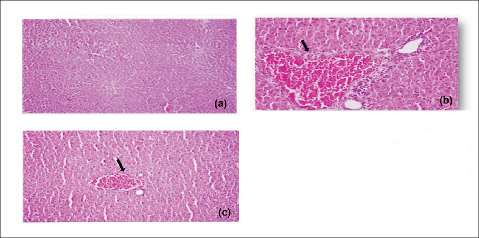 Effect of Sidh Makardhwaj on rat's liver histology. Light micrograph of (a) control liver showing normal architecture (b) 1 mg/kg/day, HgCl2 treated showing pyknosis, vascular, degenerative and necrotic changes in the liver (arrow) (c) 100 mg/kg/day, Sidh Makardhwaj treated showing pyknosis and congestion of blood vessels (arrow). Original magnification 20X.