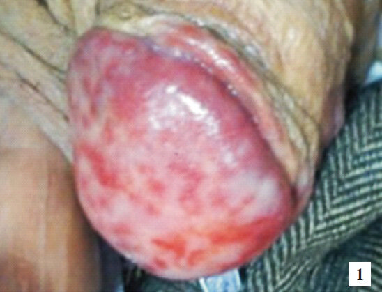 Bright red plaques in the glans penis and also in the coronal sulcus of the circumcised patient with patches of uninvolved skin.