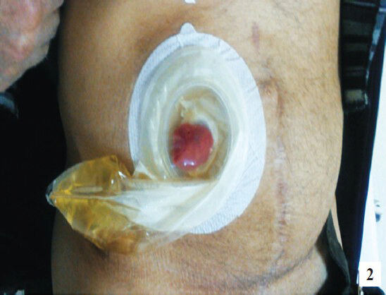 The scar related to the previous operation was observed in the examination of the abdominal wall and the outlet of the uretero-ileal loop anatomosis and the connected urine bag.