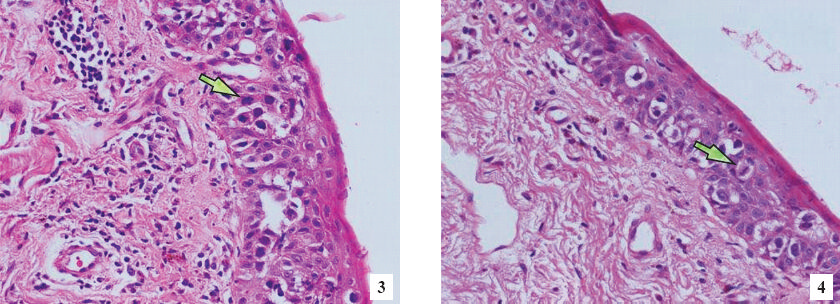 Histopathology of the biopsy material collected from the penile coronal sulcus area. Large parakeratotic cells with hyperchromatic nuclei (shown by arrow) within the thick keratin layer on the surface. In addition, there were dyskeratotic cells with large eosinophilic cytoplasms and hyperchromatic nuclei. H&E stain at magnification 400x.