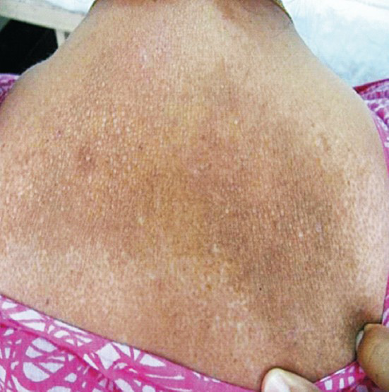 Photograph showing macular lesions in dorsocervical area indicating CLA.