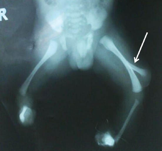 Bifid femur which has duplicated exactly at the mid-diaphyseal level.