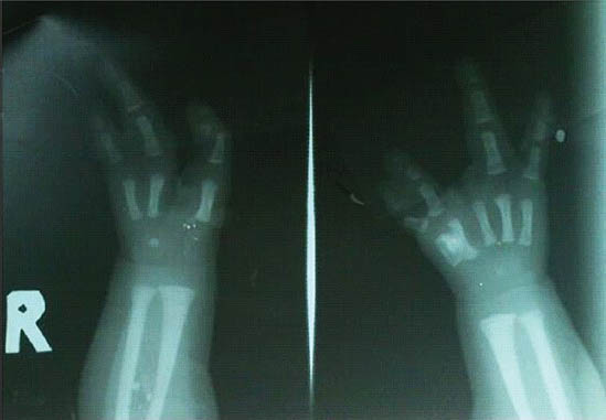 Radiographs of both hands showing absence of central ray (Lobster-claw hand).