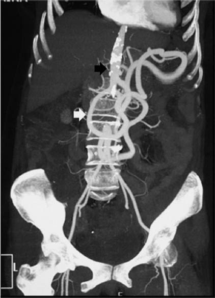 CT abdominal angiography maximum-intensity projection (MIP) image showing atherosclerotic occlusive aortoiliac disease (black arrow) with Arc of Riolan (white arrow) connecting SMA and IMA.