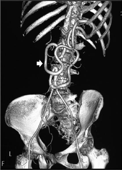 Volume-rendered 3D CT angiography image better depicting large mesenteric collateral Arc of Riolan (arrow).