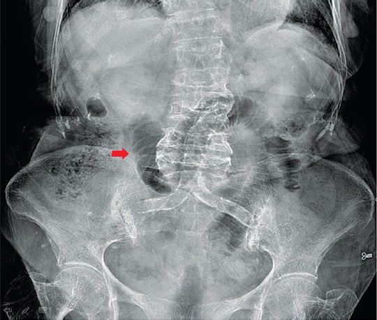 Plain abdominal radiograph showing segmental dilated loops of the small intestine in middle and lower abdomen (red block arrow).
