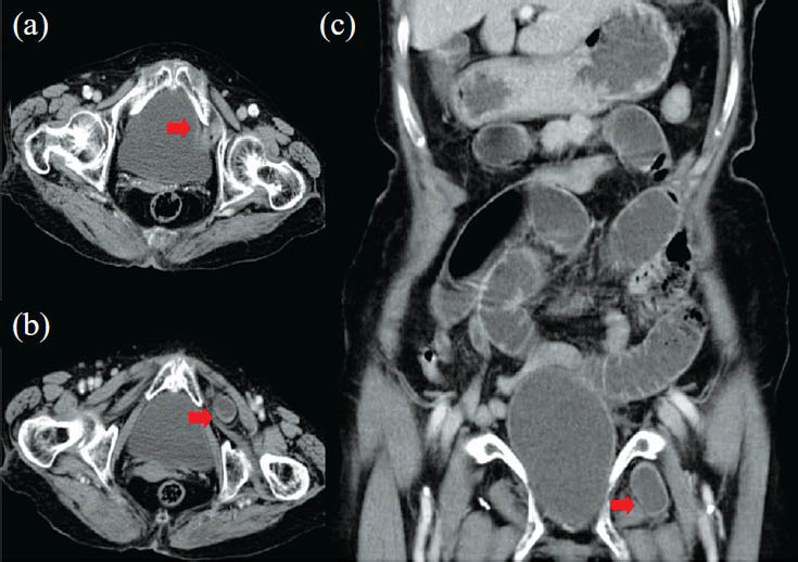 The axial CT scan of abdomen showing incarcerated bowel loop protruding into the left obturator foramen (a, b, red block arrow). The longitudinal CT image of abdomen demonstrated a small bowel loop between the left obturator externus and pectineus muscles and diffused dilatation of small bowel loops (c, red block arrow).