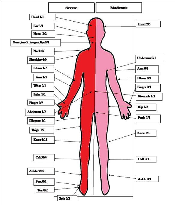 Frequency and sites of bleeding in patients with severe and moderate haemophilia A. Data from 480 patient weeks of follow up (Source: Ref. 30). The numbers indicate the total number of bleeding episodes at that site (denominator) and the number of haemmorrhagic episodes treated with clotting factor concentrate (numerator).