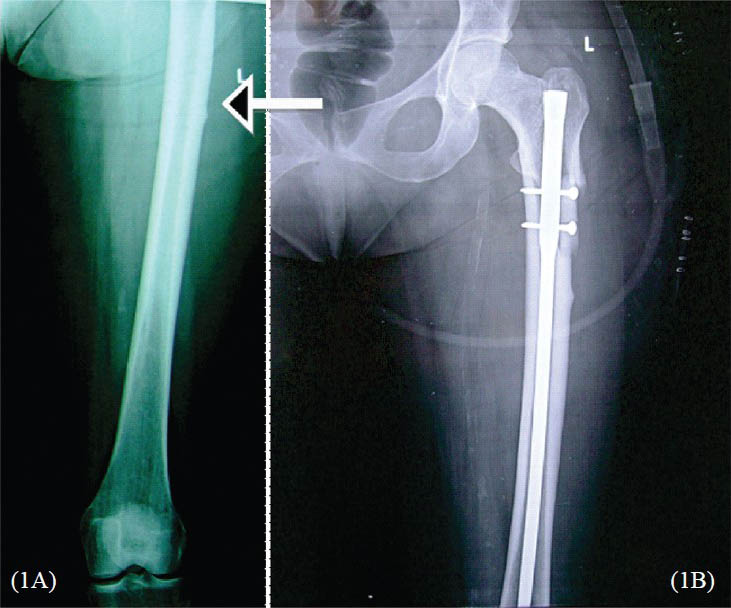 Radiograph of a 63 yr old woman showing cortical beaking at the site of prodromal pain (arrow), followed by fracture and intramedullary nailing for fracture left shaft of femur.
