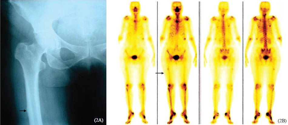 A. Radiograph of a 71 yr old woman showing cortical beaking findings in the shaft right femur (arrow). 2B. Bone scan showing small hot spot in the right proximal femur correlating with the site of stress fracture.