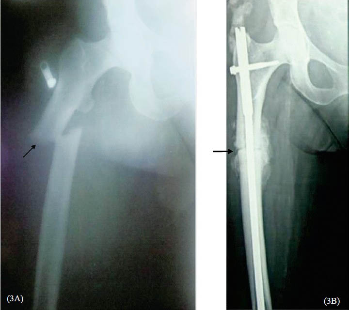 A. Radiograph of a 35 yr old woman showing subtrochanteric fracture of right femur (arrow). 3B. Radiograph showing callus formation with intramedullary nailing in right shaft of femur.