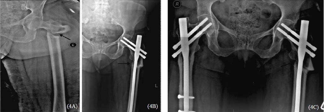 A. X-ray pelvis AP view showing subtrochanteric fracture of shaft of left femur. 4B. X-ray pelvis AP view showing subtrochanteric fracture of shaft of left femur with nailing. 4C. X-ray pelvis AP view showing bilateral subtrochanteric fracture of shaft of femur with nailing.