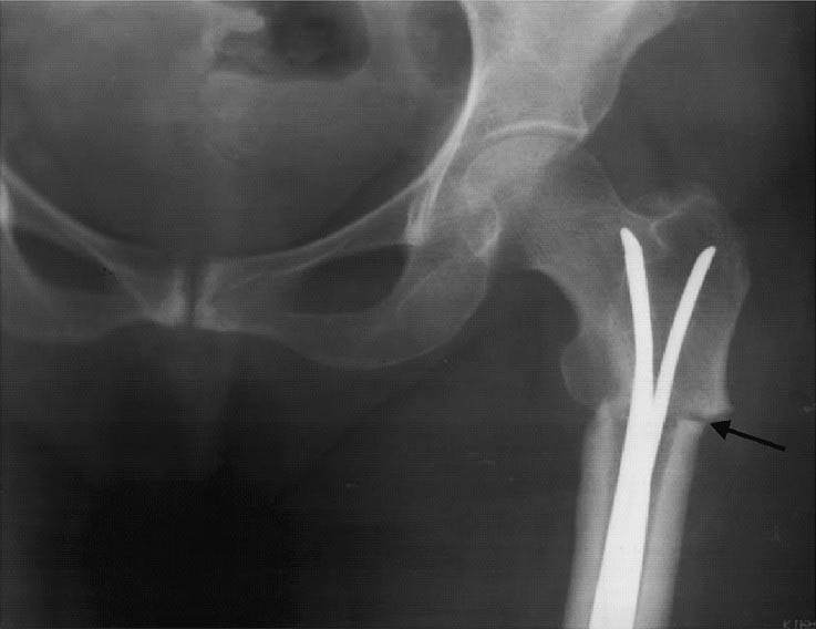 Radiograph an 83 yr old woman showing thick cortices with subtrochanteric fracture and intramedullary nail.