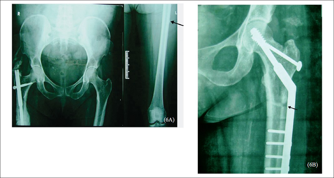 A. Radiograph a 52 yr old woman showing subtrochanteric fracture of right femur with intramedullary nail and cortical beaking of left femur (arrow). 6B. Radiograph showing subtrochanteric femur of left femur with external fixation showing thickened cortices and fracture union (arrow).