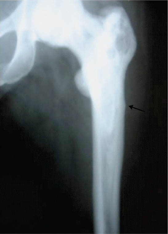 Radiograph of a 55 yr old woman showing the cortical beaking (arrow) of left femur in patients with Paget's disease and greater trochanter showing the lytic and sclerotic lesions.