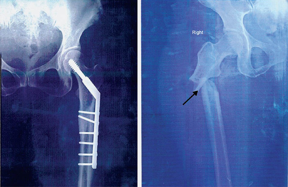 Radiograph of a 58 yr old woman of pelvis AP view nailing showing the left subtrochanteric fracture with followed by right subtrochanteric fracture (arrow).