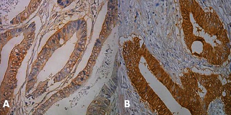 Immunohistochemistry for galectin-3. A - Moderate immunoexpression. B - Strong expression. X100 magnification.