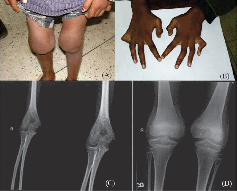 (A). Photograph of the knee joints of patient 1b showing bilateral knee joint swelling. (B) Hands of patient 1a showing contractures of the metacarpophalangeal and interphalangeal joints. (C) Elbow radiograph of patient 1a showing widening of the joint space and severe periarticular osteopenia. (D) Knee radiograph of patient 1a showing widening of the joint space and periarticular osteopenia.
