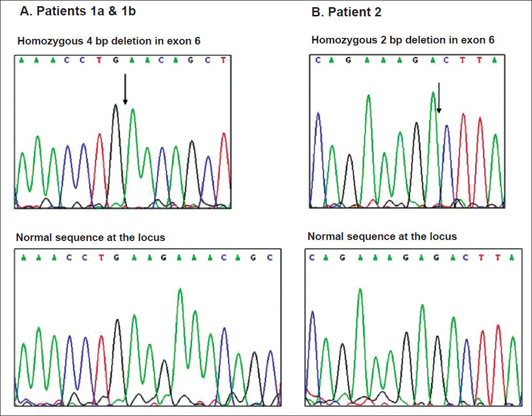 Electropherogram of wild type alleles (top) and mutant alleles (bottom) of patients 1a and 1b and patient 2. The sites of homozygous deletion are indicated by arrows.