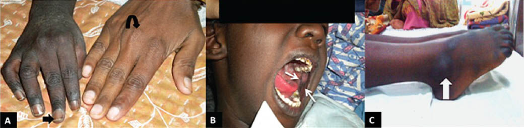 (A). Clinical photograph of the child showing generalized hyperpigmentation compared to mother's hand (curved arrowhead) and hyperpigmented nail (arrowhead). (B) Picture showing mucosal hyperpigmentation (arrows). (C) Image showing hyperpigmented lateral malleolus-pressure point (arrow).