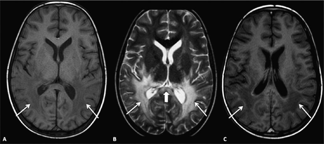 (A). Axial MR brain T1WI showing abnormal hypointense signal intensity involving peritrigonal region (arrows). (B) Axial MR brain T2WI showing abnormal hyperintense signal involving the peritrigonal region (arrows) and splenium of corpus callosum (thick arrow). (C) Axial MR brain T1 post- contrast image showing enhancement of the intermediate zone (arrows).
