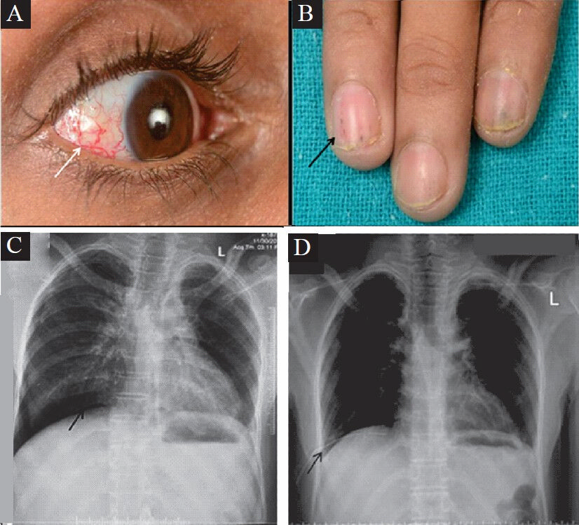 Clinical photograph showing (A) ocular and (B) nail telangiectasia (arrows). Baseline X-ray chest posteroanterior (P/A) view (C) displayed right epidiaphragmatic and apical hyperlucencies (arrows) suggestive of pneumothorax with subsequent resolution of pneumothorax following insertion of intercostal tube (D) (arrow).