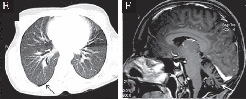 Computerized tomograph of the chest (E) revealed presence of pneumothorax (arrow) with no parenchymal changes. Cranial MRI (F) depicted cerebellar atrophy (white arrow) without cerebral cortical parenchymal changes.
