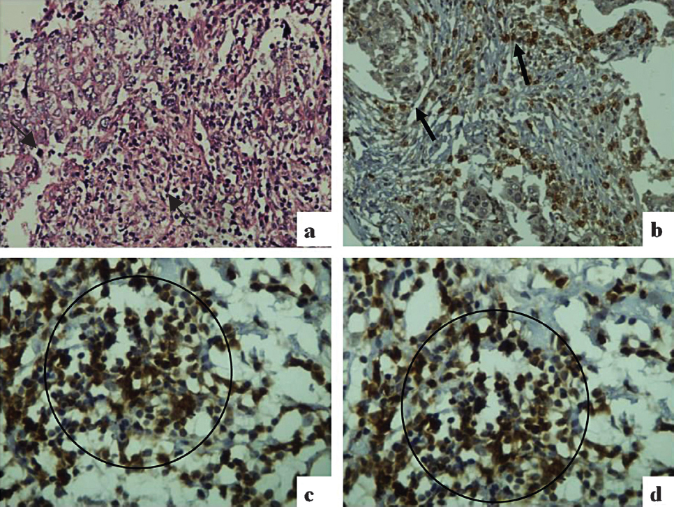 (a) Histological section from infiltrating ductal carcinoma (IDC) breast showing intratumoural and stromal TILs (black arrows) (Hematoxylin & Eosin (HE) × 200); (b) Intratumoural and stromal CD3+ TILs in IDC (black arrows) (Immunostain ×200); (c) Intratumoural CD4+ TILs in IDC (black circle) (Immunostain × 400); (d) Stromal CD8+ TILs in IDC (black circle) (Immunostain ×400).