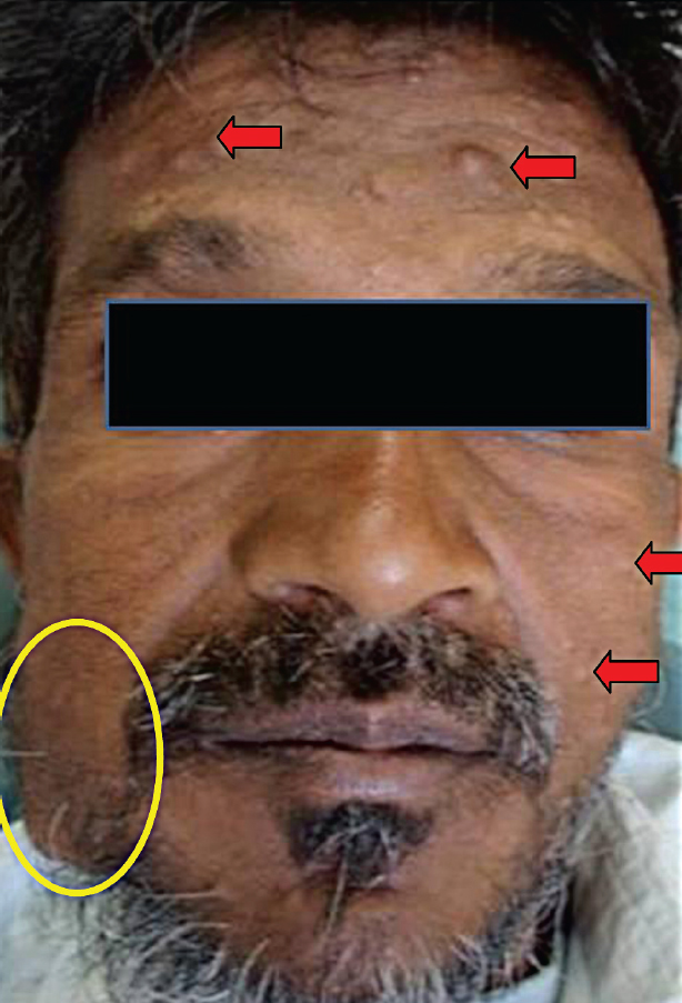 Extra-oral right mandibular swelling (circle) with multiple lesions of neurofibromas (arrows).