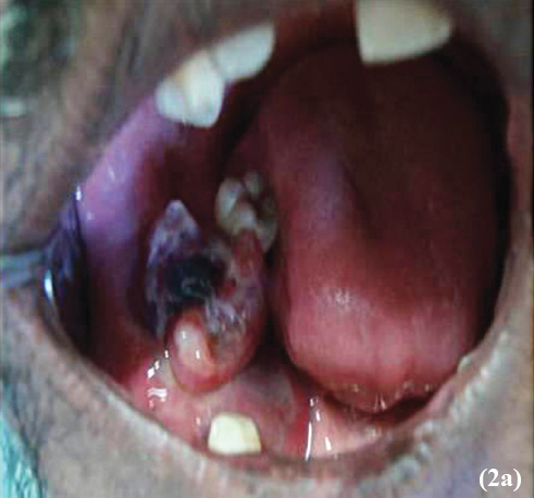 Small intra-oral lesion growing on the right mandibular alveolus.