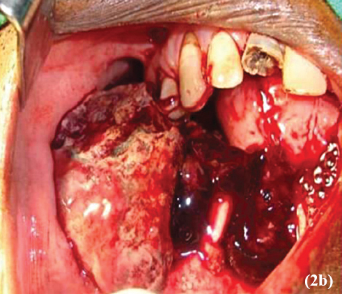 Rapidly growing lesion after inicisional biopsy almost filling up the entire oral cavity, measuring 7×5 cm in size.