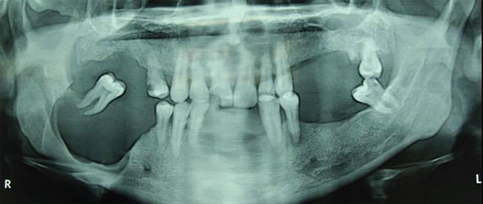 Orthopentomogram shows well defined osteolytic lesion in the mandible.