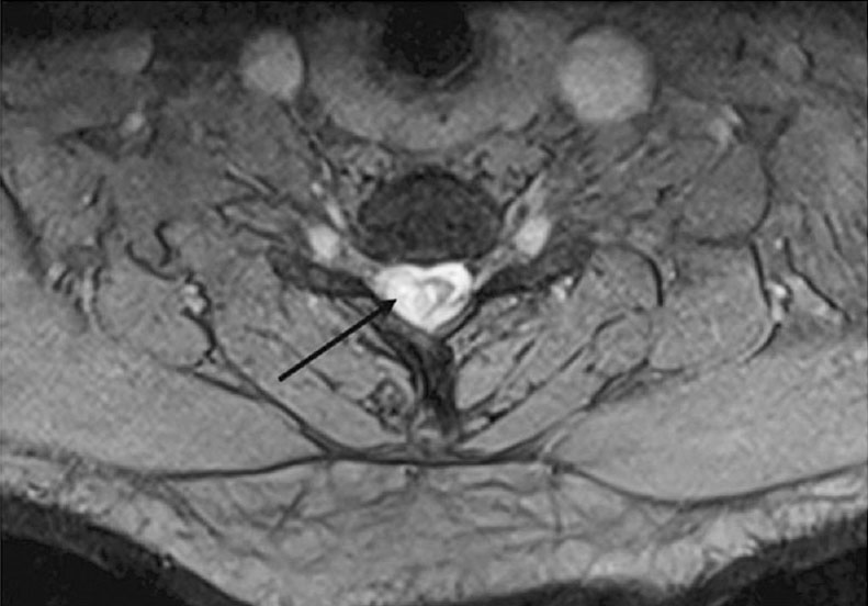 Axial gradient MR image showing hyperintensity (black arrow) in right side of lower cervical spinal cord. Involved part of cord also appears oedematous.