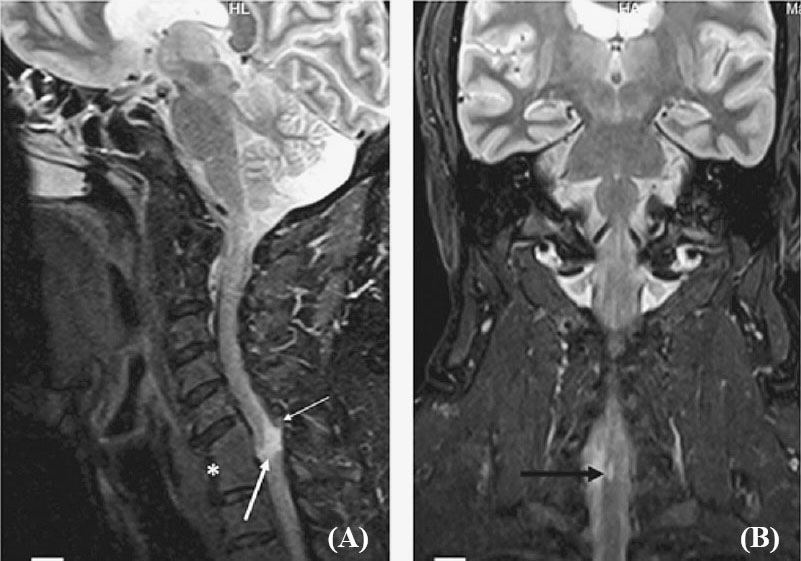 (A) Sagittal short tau inversion recovery (STIR) MR image showing C6-C7 block vertebra (white asterisk) with a focal linear hyperintensity in spinal cord (thick white arrow) at this level. Focal disruption of ligamentum flavum is also noted (thin white arrow). (B) Coronal STIR MR image showing focal hyperintensity confined to right side of cervical spinal cord (black arrow).