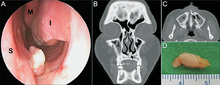 Intranasal ectopic tooth. (A) The rhinoscopic image of a whitish tooth covered with a mucosal membrane in the left nose. S, nasal septum; M, middle turbinate; I, inferior turbinate. (B) and (C) Pre-operative coronal and sagittal computed tomography imaging of the paranasal sinuses, depicting a tooth in the left nasal cavity (black arrow). (D) The removed tooth was complete with a length of 14 mm.
