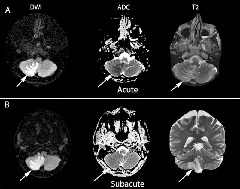 MRI findings in acute and subacute strokes. (A) During acute stroke, infarct regions appear hyperintense on diffusion-weighted imaging, and hypointense on ADC maps (white arrows); they are invisible in T2-weighted images and Flair during the first 12 h, although some regions of acute infarct might start being noticeable in T2-w in the 12-24 h period, as in this case. (B) Same patient as in A, imaged in the early subacute period; DWI might increase a little. Although the ADC map depicts the return of diffusion values to normal, T2-w clearly demarcates the extension of the brain infarct (white arrow).