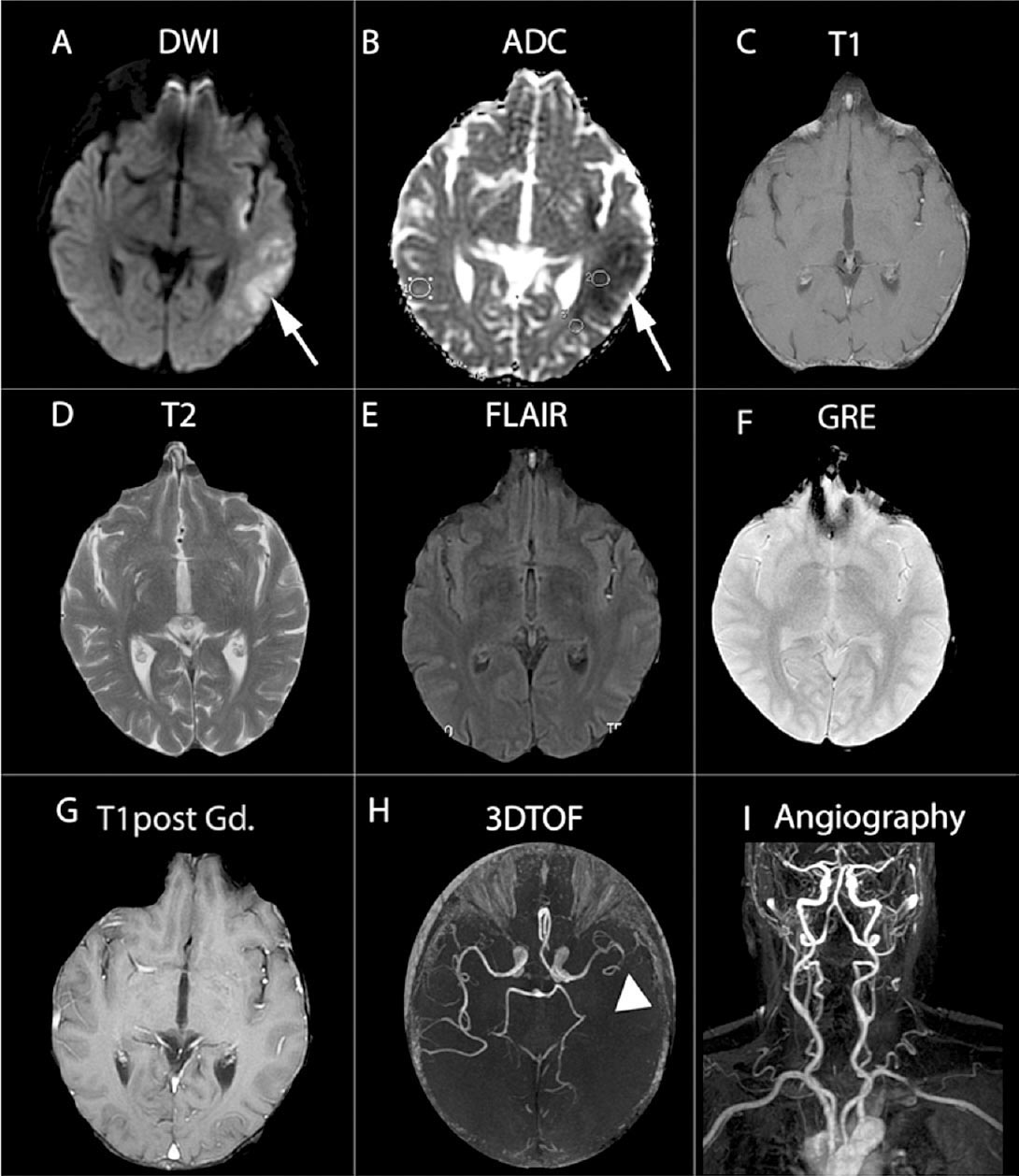 Comprehensive MRI assessment in acute stroke using DWI, PWI and MR angiography. Selected images depict an acute ischaemic infarct (white arrows), which is visible only in A, the diffusion-weighted imaging (DWI); B, the apparent diffusion coefficient map (ADC); and H, the three-dimensional time-of-flight (3D-TOF); in this last sequence, a white arrowhead (image 3H) indicates the occlusion of the M2 segment in the left middle cerebral artery. The rest of sequences in the protocol: C, T1; D, T2 weighted images; E, Flair; F, gradient-echo imaging (GRE); G, T1 post gadolinium administration; and I, carotid-artery MR angiography did not depict conspicuous findings.