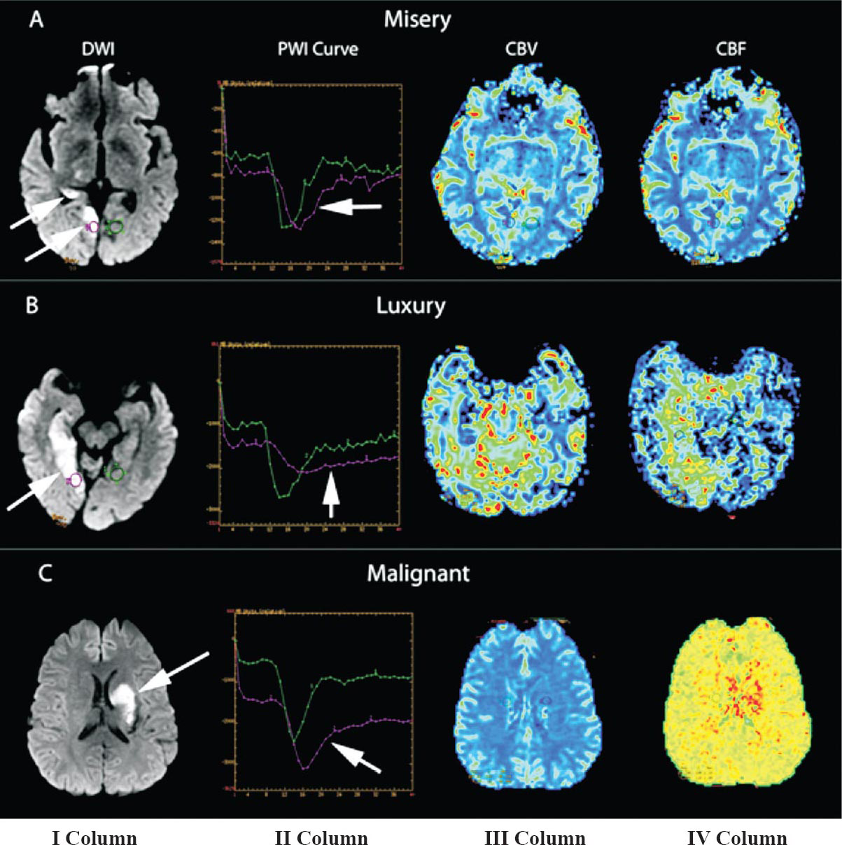 Diffusion-Perfusion analysis in acute ischaemic stroke. I column, location of the infarct core using diffusion weighted imaging (selected ROI is indicated by a small white oval shape); II column, perfusion-weighted imaging (PWI) profiles with their corresponding perfusion curves of cerebral blood volume (CBV) and cerebral blood flow (CBF); III and IV columns, CBV and CBF parametric maps of brain perfusion.