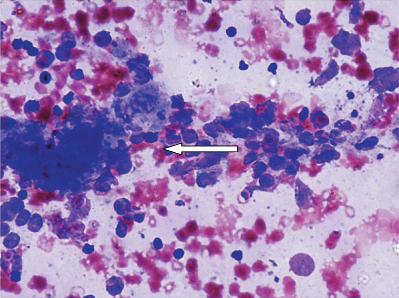 Prominent lymphoplasmacytic infiltrate of thyroid (arrow) in Hashimoto's thyroiditis (May-Grunwald-Giemsa stain, ×400).