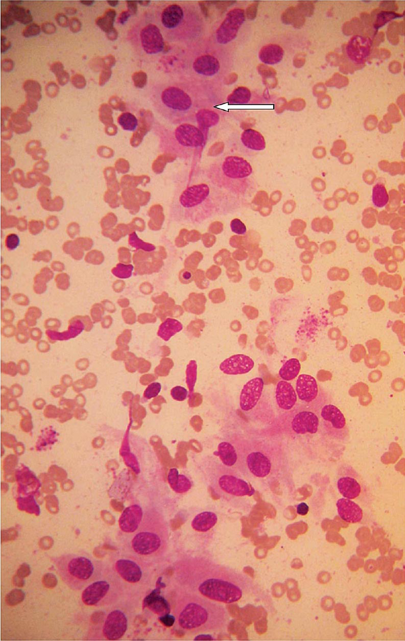 Hashimoto's cell change of follicular cells of thyroid (arrow) in Hashimoto's thyroiditis (May-Grunwald-Giemsa stain, ×400).