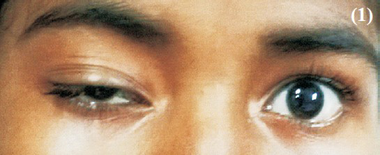 Drooping of right upper eyelid - weakness of levetor palpabrae superioris supplied by third cranial nerve.