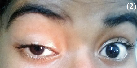 Absence of ipsilateral light reflex - pupil of right eye remains dilated even after fall of light beam along with ipsilateral drooping of upper eye lid.