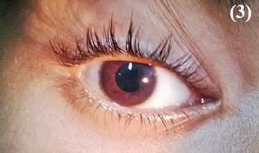 Absence of ipsilateral light reflex - pupil of right eye remains dilated even after fall of light beam.