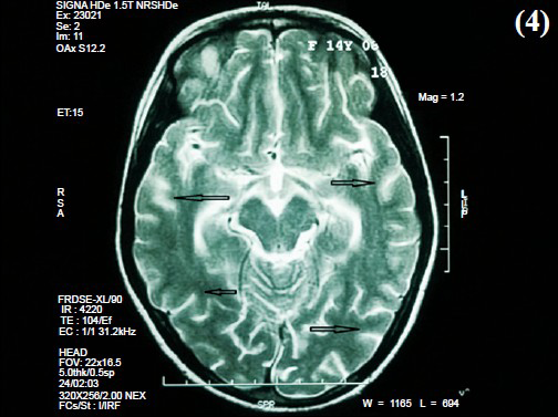 Effacement of cortical sulci (arrows) - Sequelae of encephalomyelitis.